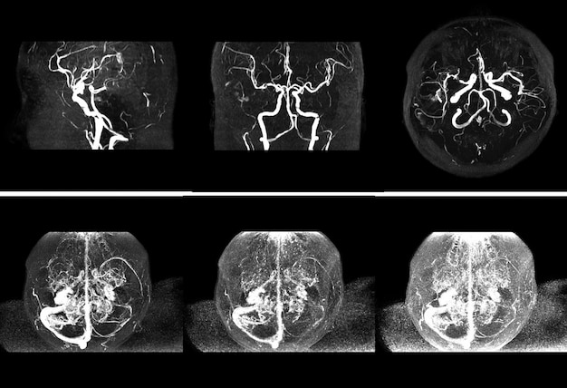 Mri Of The Blood Vessels In The Brain And Cerebrovascular Disease Or Or ...