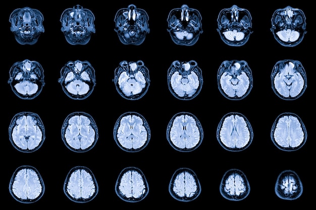 Premium Photo | Mri brain and orbit showing occupying at left anterior ...