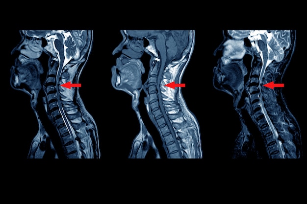 Mri of cervical spine : moderate to severe posterior central disc protrusion of c3/4 to c5/6 intervertebral discs with a 2.0 cm in length small posterior subligamentous fluid collection.on red point Premium Photo