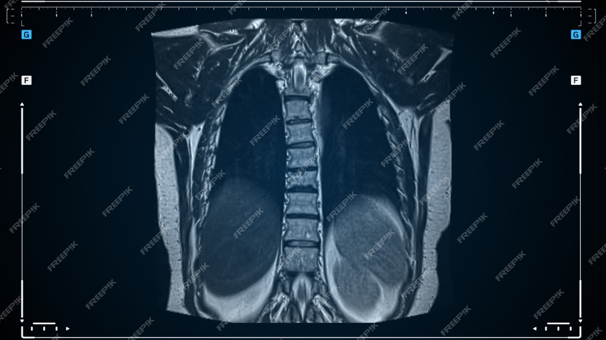 Premium Photo | Mri lung scan, magnetic resonance imaging of a back and ...