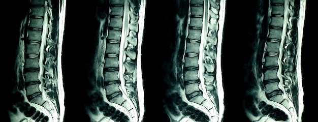 Premium Photo | Mri scan of lumbar spines of a patient with chronic ...