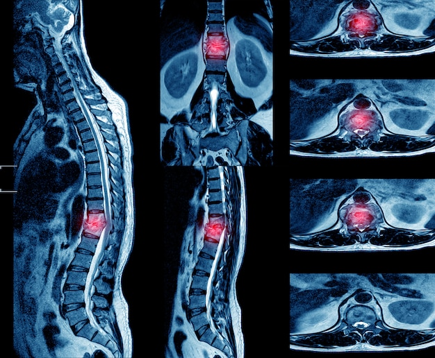 Premium Photo | Mri of the thoracic spine history: a 62-year-old male ...