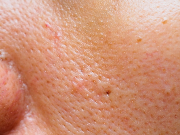 Premium Photo | Pimple and acne on face skin, zoom macro.