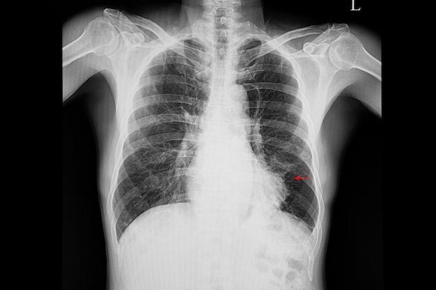 Premium Photo Pneumonia At Left Lower Lung