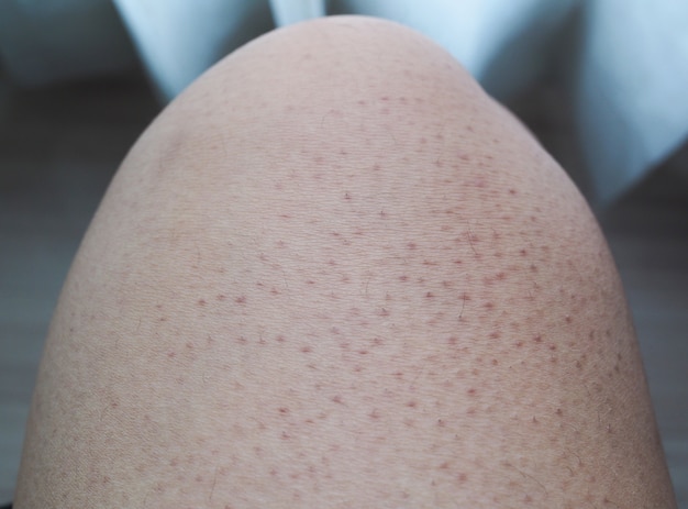 How To Get Rid Of Large Pores On Your Legs