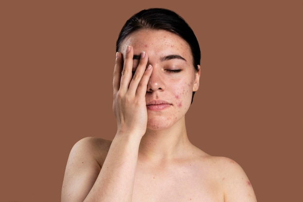 Portrait of young woman being confident with her acne Free Photo