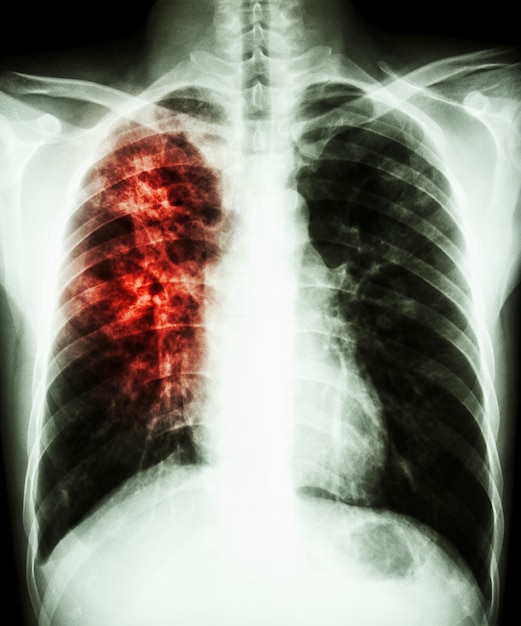 Pulmonary Tuberculosis Chest X Ray