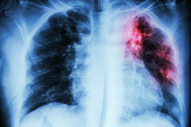 Pulmonary tuberculosis Premium Photo