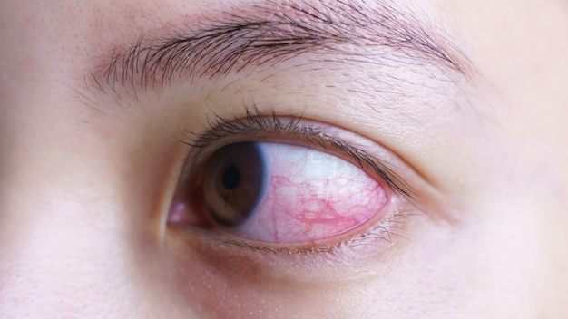 Red bloodshot eye of woman, irritated or infected, conjunctivitis eye or after cry. Premium Photo