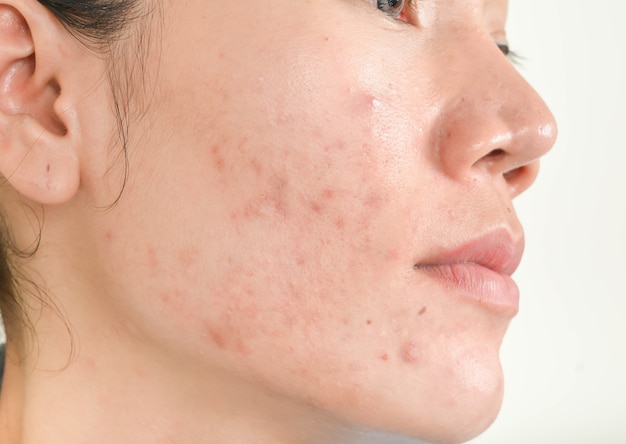 Scar from acne on face Premium Photo
