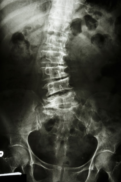 mid lumbar spine