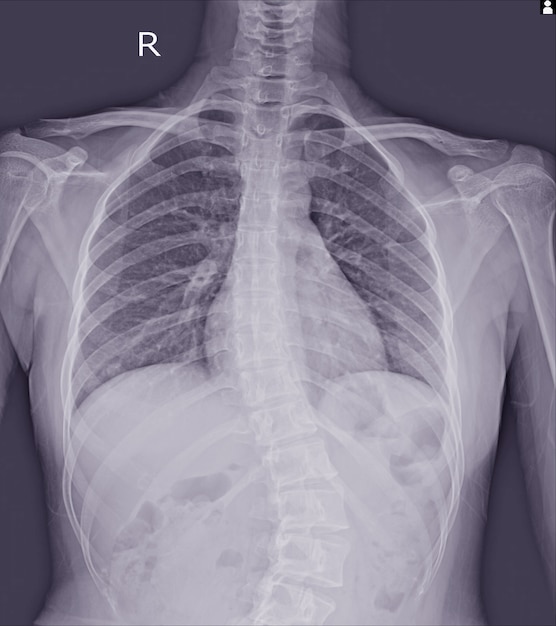 Scoliosis film xray show spinal bend in teenager patient