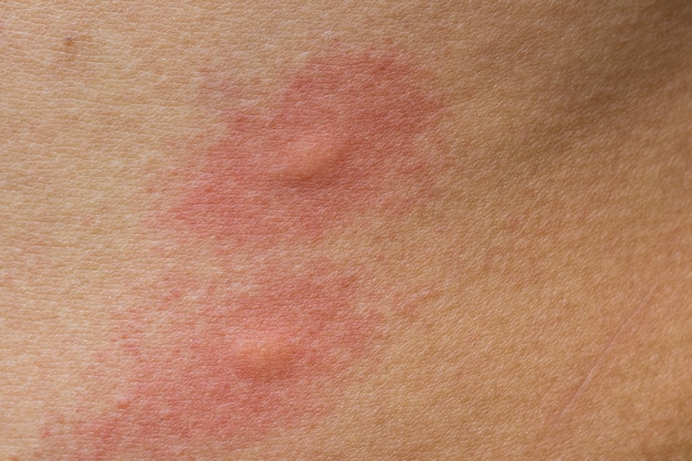 Scratch allergic skin from mosquito or insect bites | Premium Photo