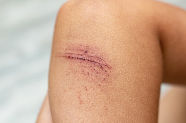 definition-of-abrasion-wound-abrasion-medical-the-wearing-down-of