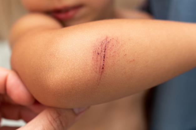 Premium Photo | Scratch, wound, abrasion on the kids elbow