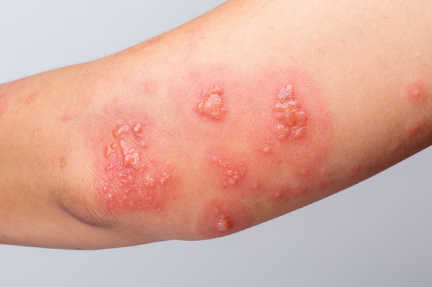 Shingles, zoster or herpes zoster symptoms on arm Premium Photo