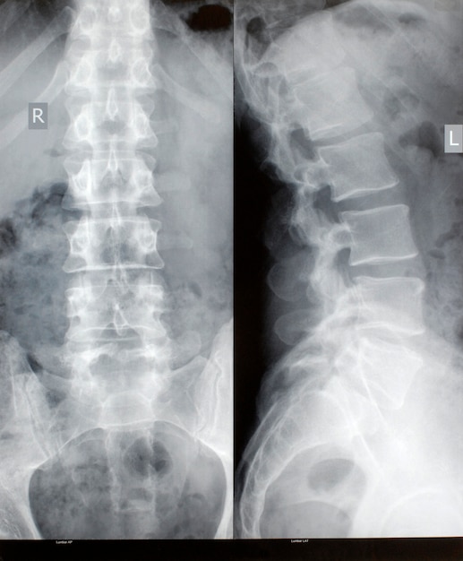 free photo spine x ray