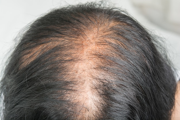 Thin Hair And Scalp Problems And Broken Hair Premium Photo