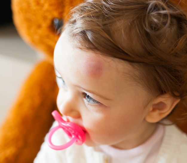 Premium Photo Toddler With Big Bruise On His Forehead After Bumping