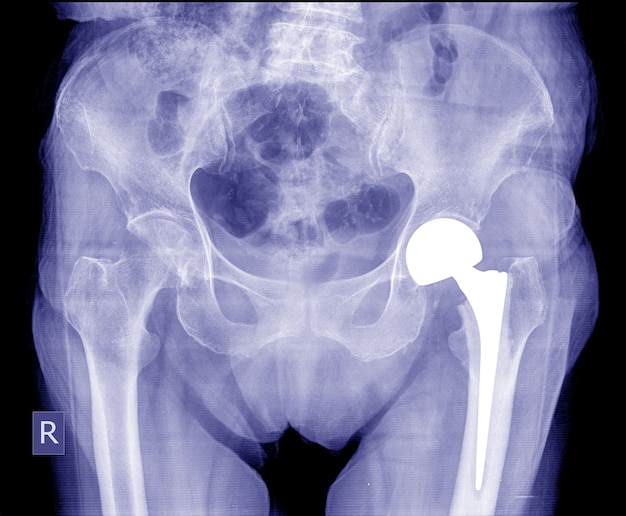 normal hip replacement xray