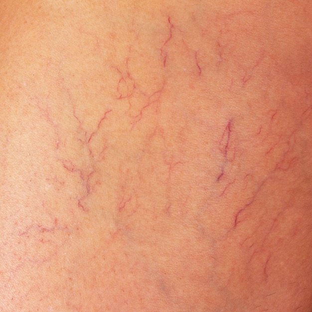 Sclerotherapy Of Vulvarperineal Varicose Veins