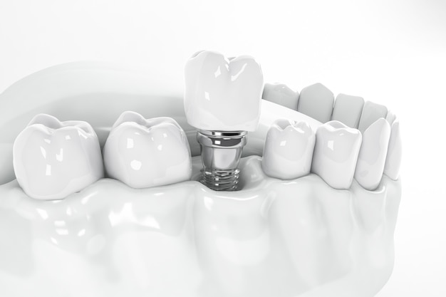 Premium Photo View From Above Of A False Tooth Implant Fixed In The Jawbone 3d 3d Illustration