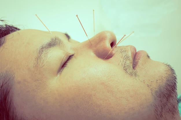 Benefits of Acupunture Treatment