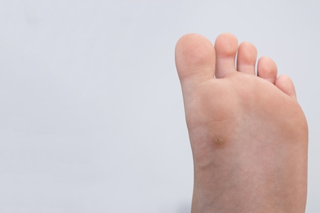 Premium Photo | Wart, papilloma on a feet. macro shot, selective focus ...