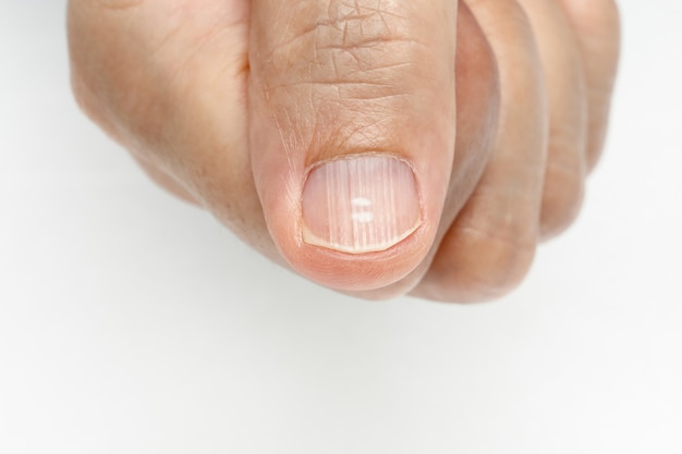 指の爪の白い斑点と垂直の尾根症状欠乏ビタミンとミネラル プレミアム写真
