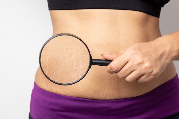 Women show off the belly after birth stretch marks on white background Premium Photo