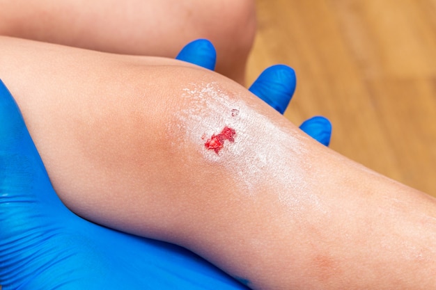 Premium Photo Wounds Scratches Abrasions On The Child Knee Close Up