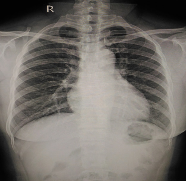 X-ray chest mild cardiomegaly Photo | Premium Download