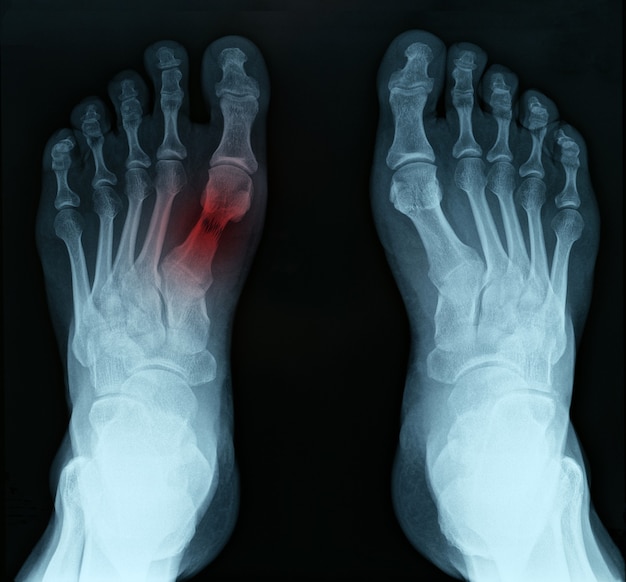 Premium Photo | X ray of feet with tarsal fracture closeup