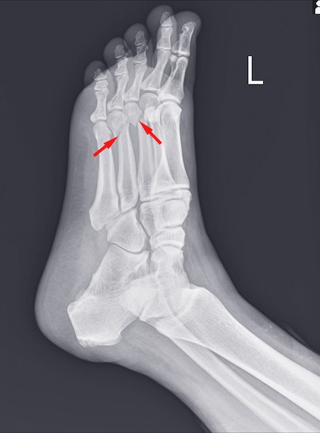 Premium Photo X Ray Foot And Ankle Showing Metatarsal Fractures