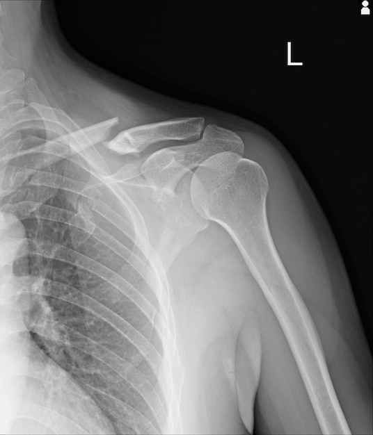 X-ray fractures left clavicle, anterior 2nd rib, posterior rib 4,5 lateral aspect of left Premium Photo