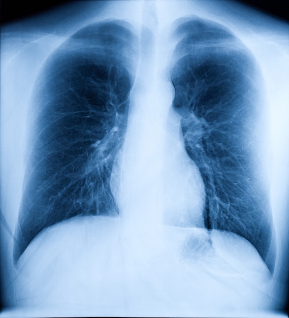 Premium Photo | X-ray image of human chest