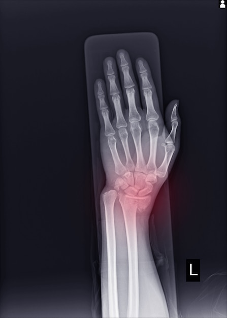 X-ray left wrist joint fracture with displacement distal end left ...