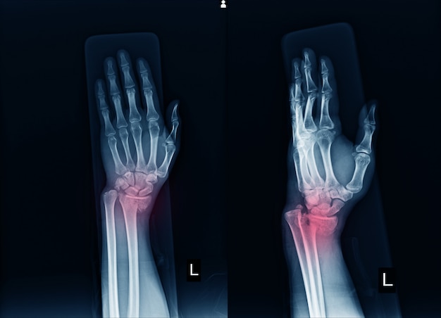 X-ray left wrist joint fracture with displacement distal end left radius. Premium Photo