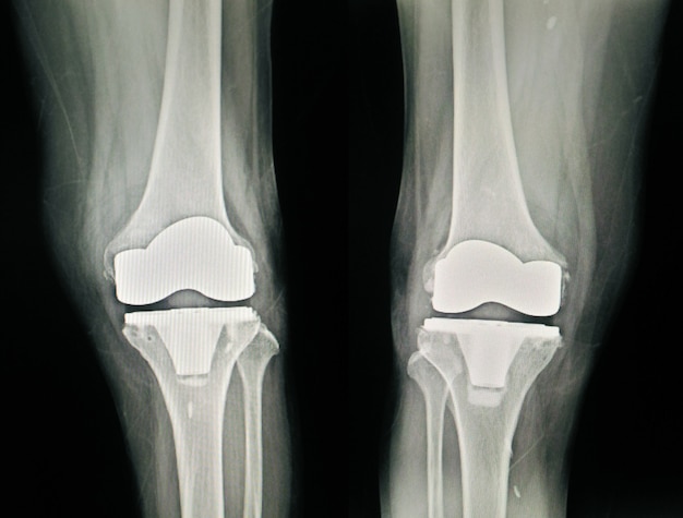 Premium Photo | X-ray Post Operation Total Knee Arthroplasty(tka)view