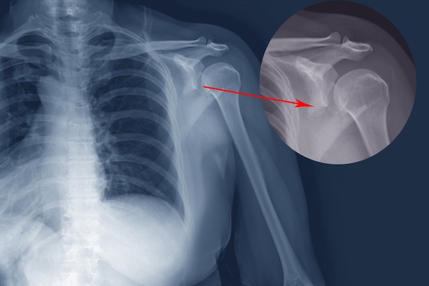Перелом копчика фото рентген