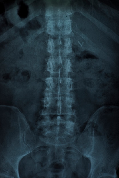 x ray of a vertebral column free photo