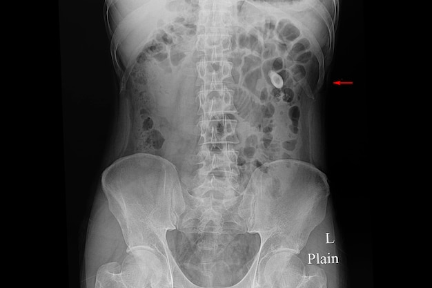 Premium Photo Xray Film Of A Patient With Kidney Stones