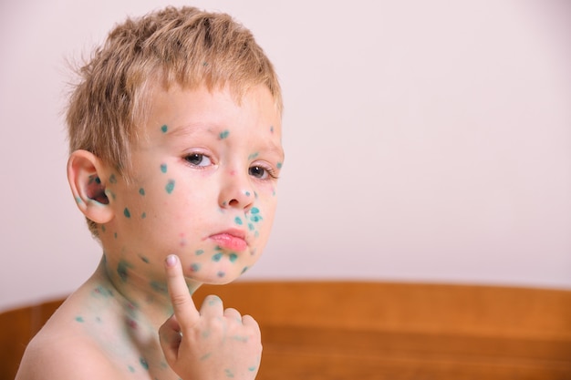 若い幼児 水痘を持つ少年 水痘と病気の子供 子供の体や顔に水痘ウイルスや水痘の発疹 プレミアム写真