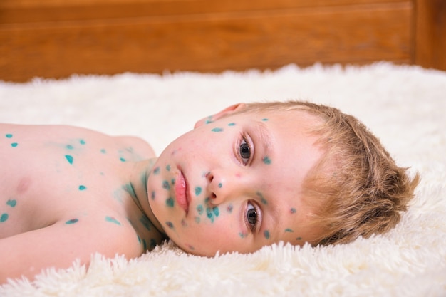 若い幼児 水痘の少年 水痘の病気の子供 水痘ウイルスまたは水痘の泡が子供の体と顔に発疹を起こします プレミアム写真
