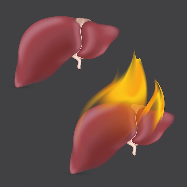 解剖学的肝臓の燃焼 炎の内部消化システムの現実的な人間の臓器 図 プレミアムベクター