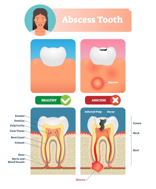 膿瘍歯のイラスト 構造とラベルの付いた医療図 プレミアムベクター
