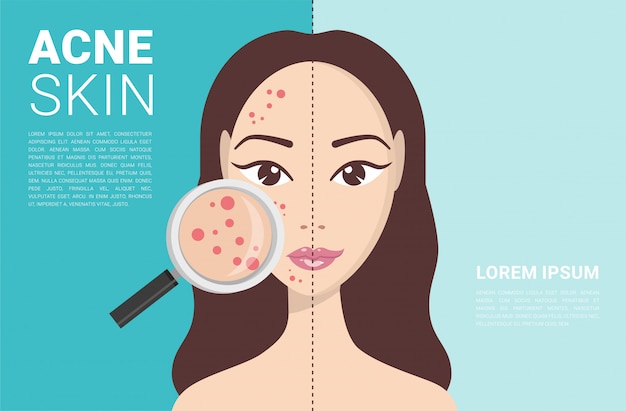 Acne, skin problems, stages of acne. Premium Vector