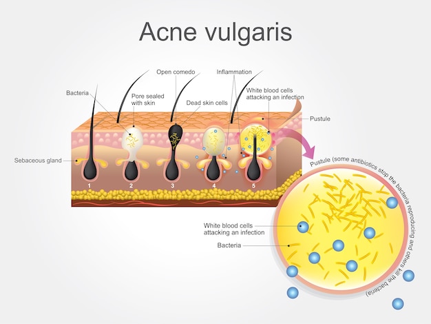 Premium Vector Acne Vulgaris