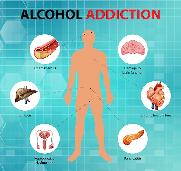 Free Vector | Alcohol addiction or alcoholism information infographic