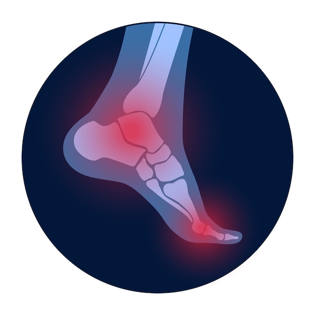 Premium Vector Arthritis Foot Joint Rheumatoid Pain In Leg Flat